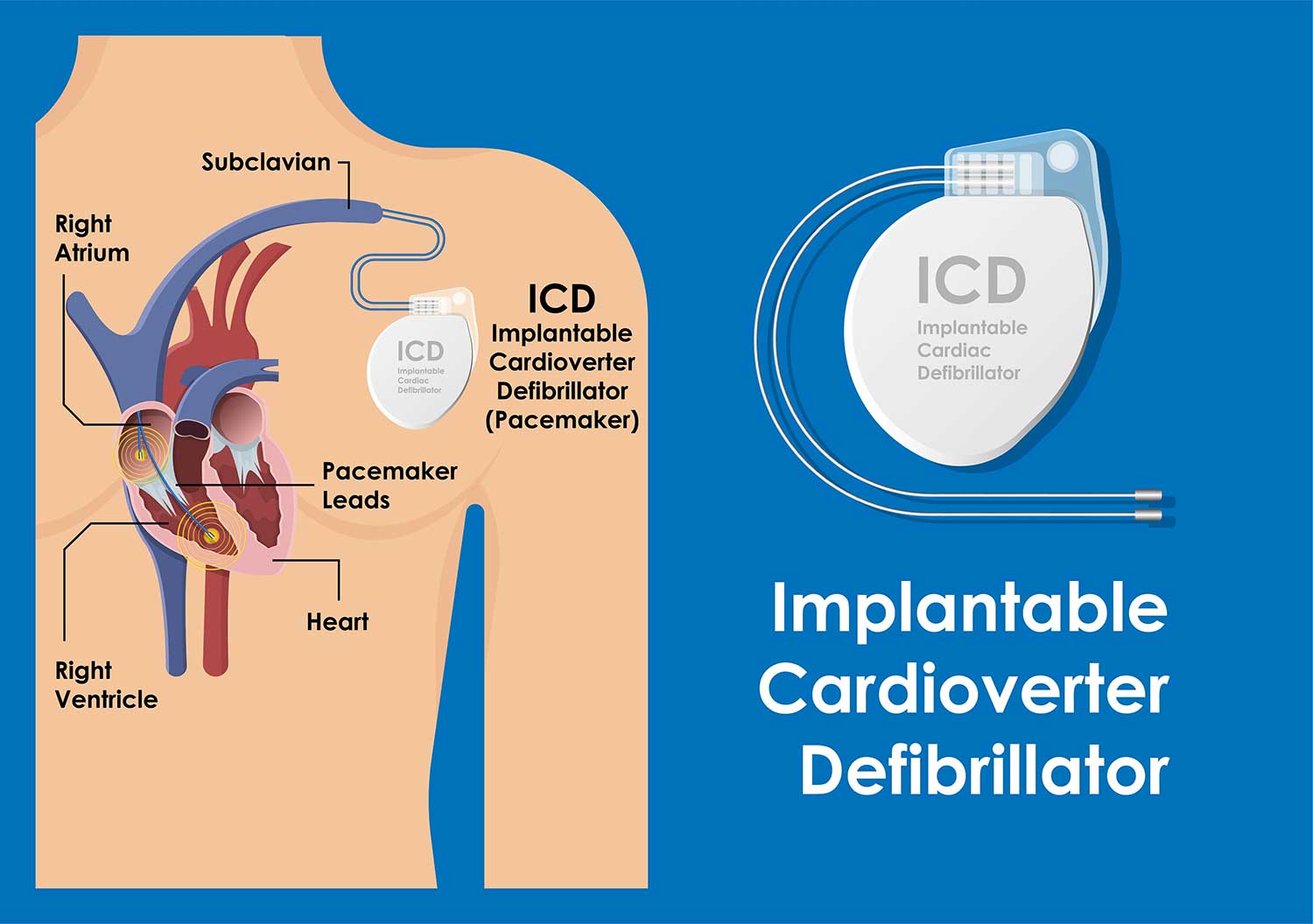 Implantable Cardiac Defibrillator 1500 