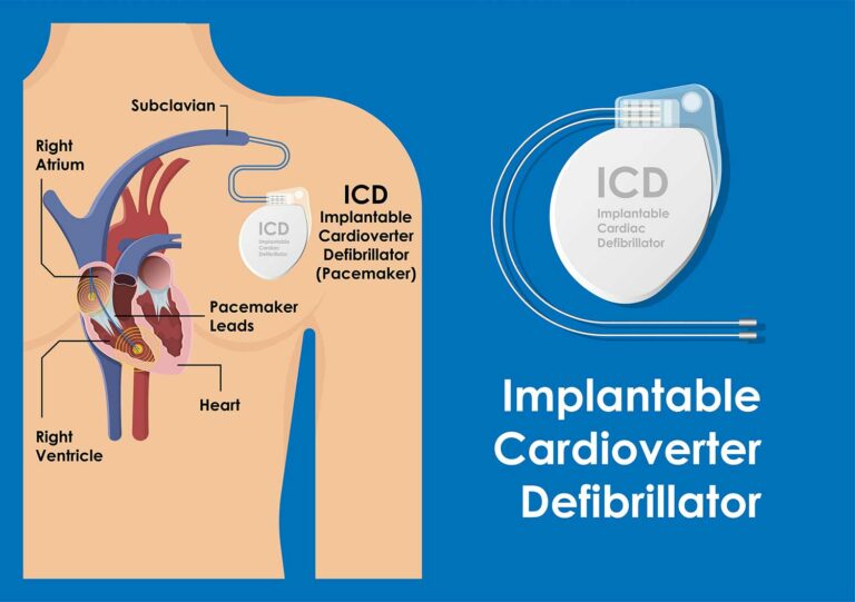 Implantable Cardiac Defibrillator – Australian Cardiovascular Specialists