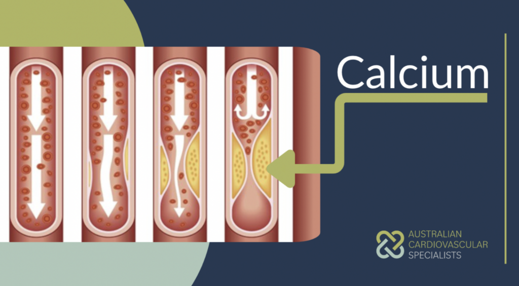Calcium build up in an artery - Australian Cardiovascular Specialists