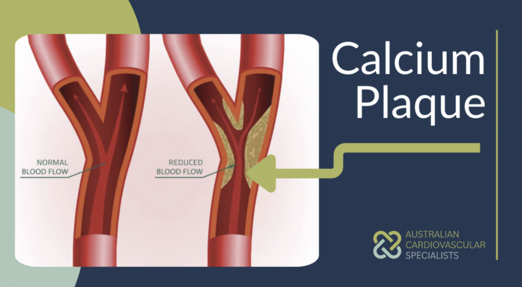 Calcium plaque build up visual example - Australian Cardiovascular Specialists